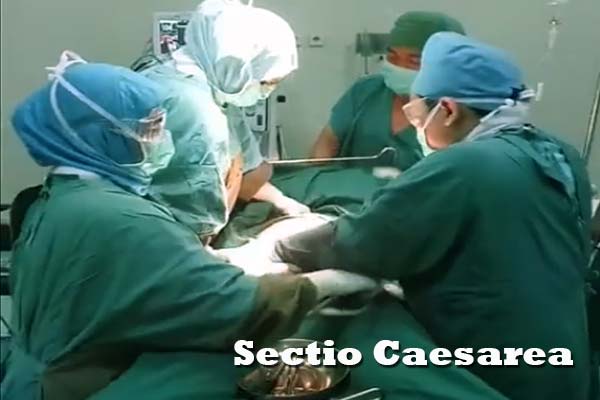 Sectio Caesarea